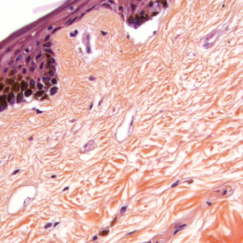 Histological section of human skin tissue under a microscope showing epidermis and dermis layers stained in purple and pink.