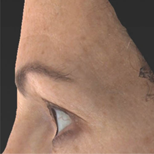 Side view of a human face with visible skin texture, focusing on the area around the eye.