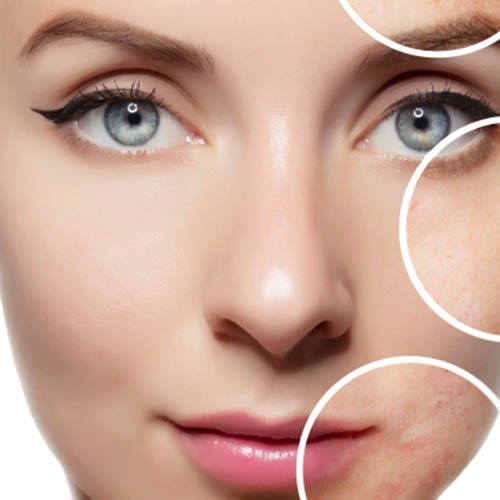 Close-up of a woman’s face with a clear complexion, with highlighted circles showing areas of skin imperfections like redness and blemishes.