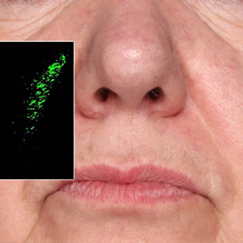 Close-up of an older woman’s face with inset showing a green fluorescent image, likely representing a skin condition or microscopic analysis.